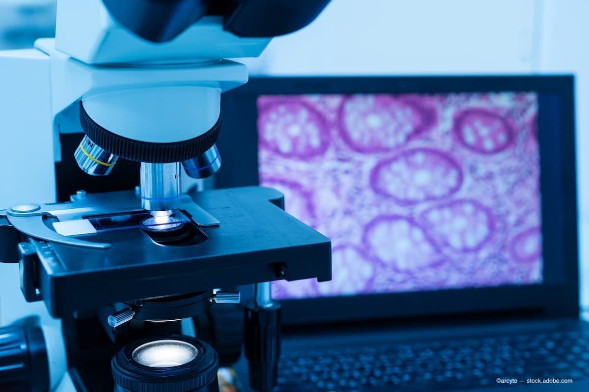 Modern microscope and human tissue section slide with computer monitor show glandular image.(Image Credit: AdobeStock/arcyto)