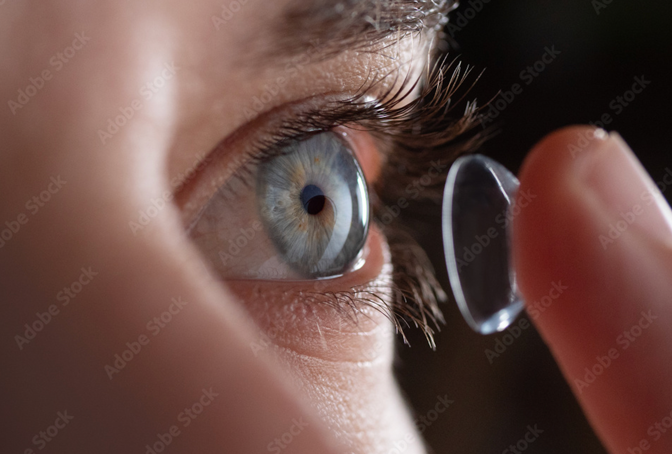 A California ophthalmologist removed 23 contact lenses from a patient's eye. (Adobe Stock illustration)