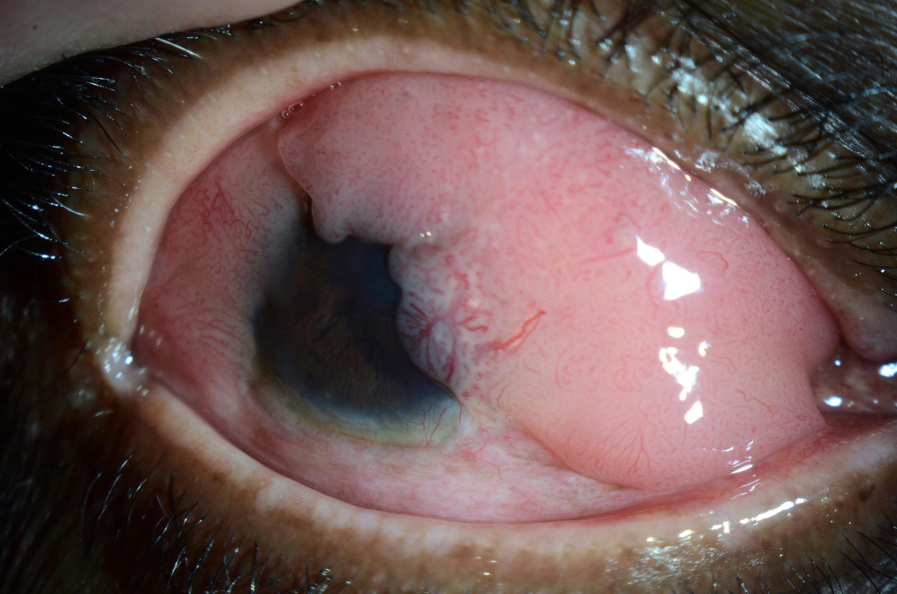 Ocular surface tumors are rare but serious events, and can be deadly for patients. (Image courtesy of Andrea Leonardi, MD)