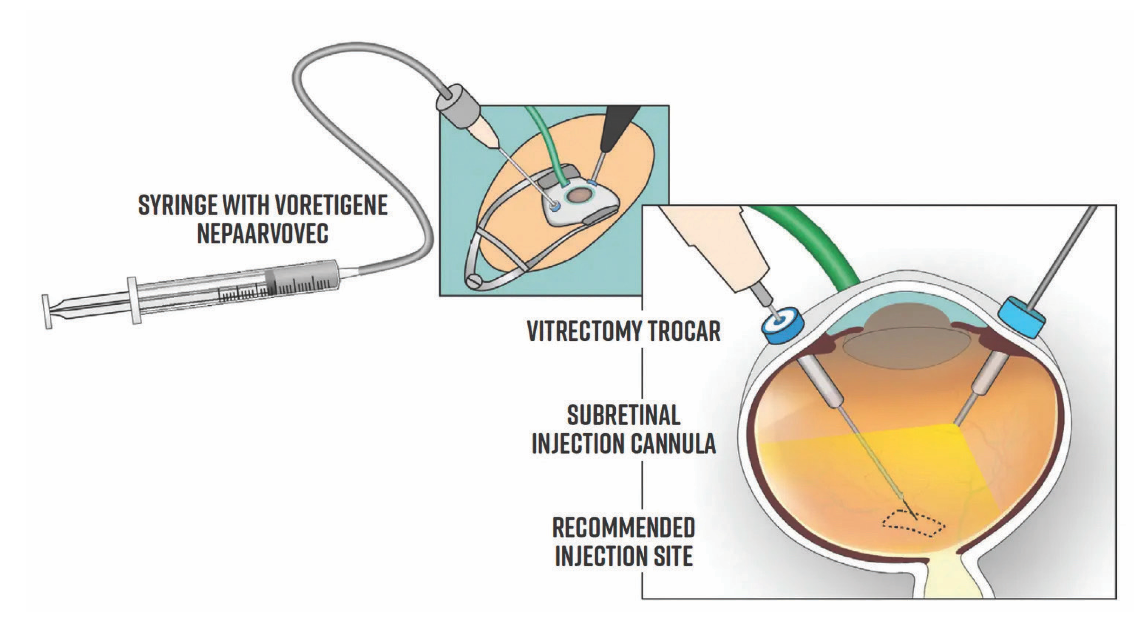 Principle of application of gene therapy with voretigene neparvovec.(Images courtesy of LMU Eye Hospital)


