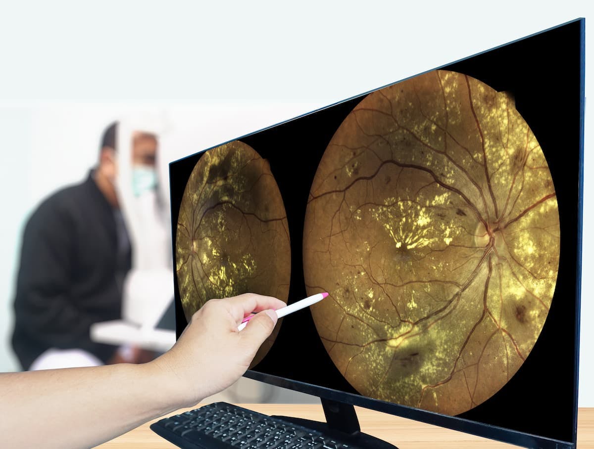 Retina diabetic checkup image on a computer screen. (Image Credit: AdobeStock)