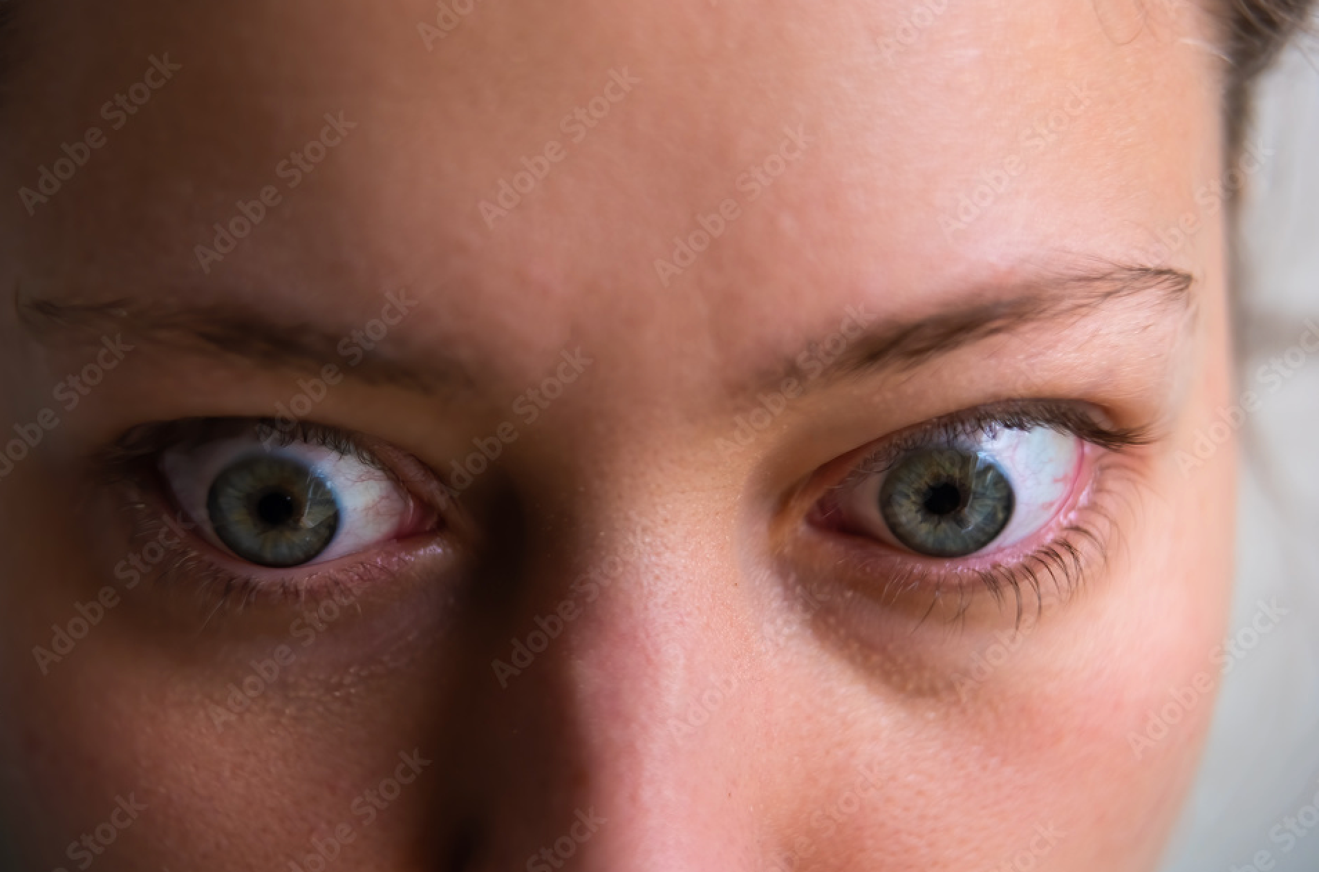Researchers are currently looking for improved detection of thyroid eye disease in patients.