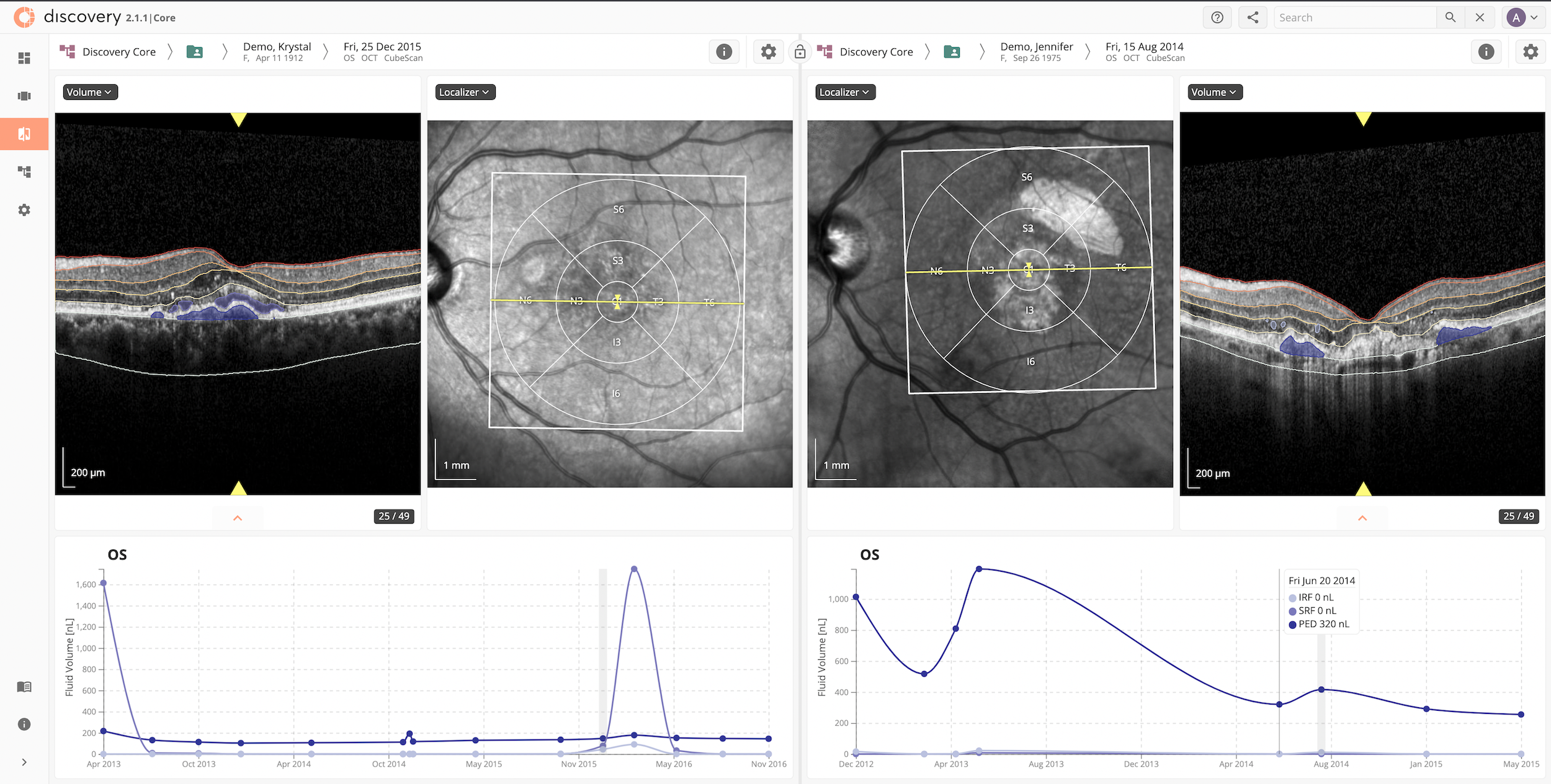 A look at the Discovery CORE platform and its AI. Features displayed include the overlay of AI on OCT images to visualize fluid and layers, side-by-side imaging comparisons on two different time-points or visits, and at the bottom, progression plots for retinal fluid volume of a patient over time. (Images courtesy of RetinAI)