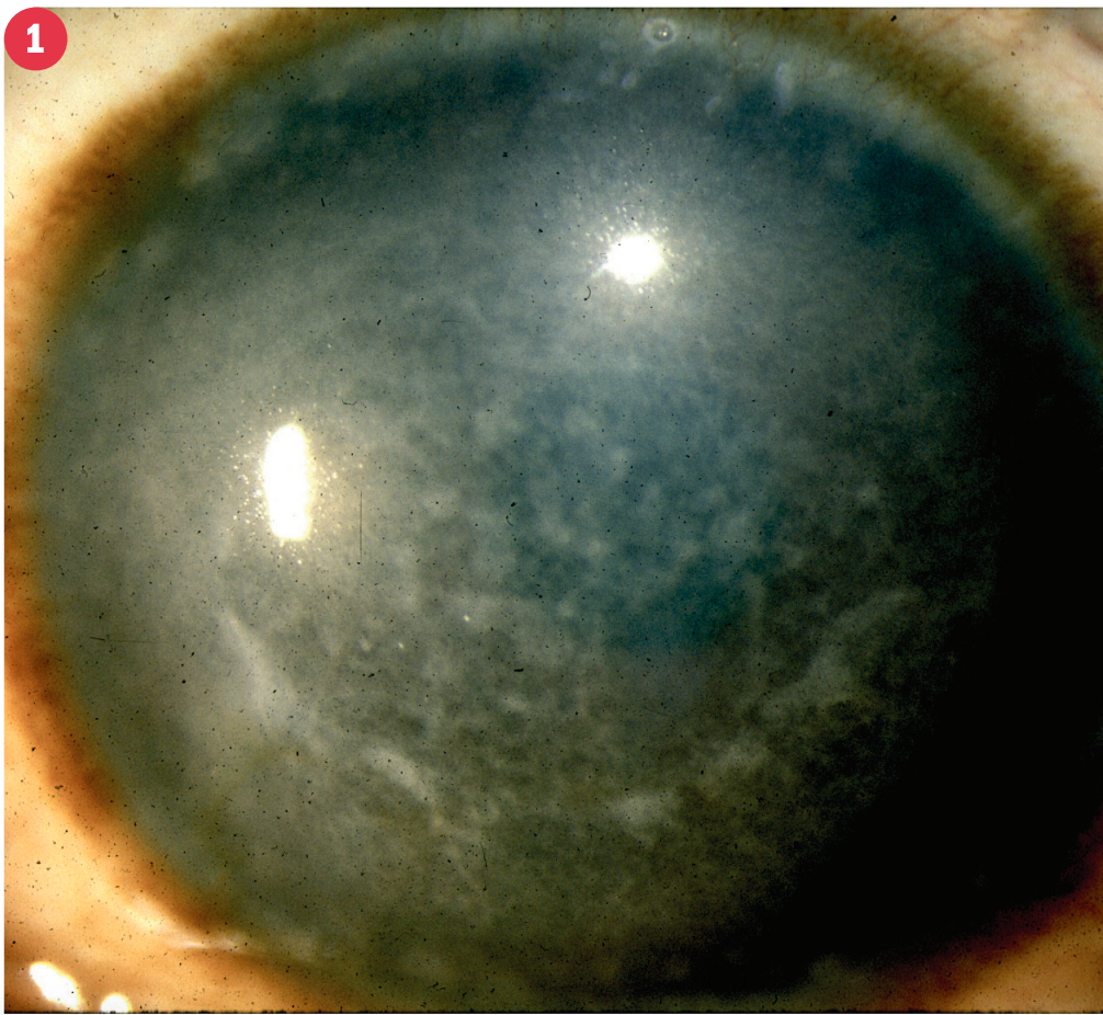 (FIGURE 1) This image shows a macular dystrophy. (Photo courtesy of Robert S. Feder, MD)