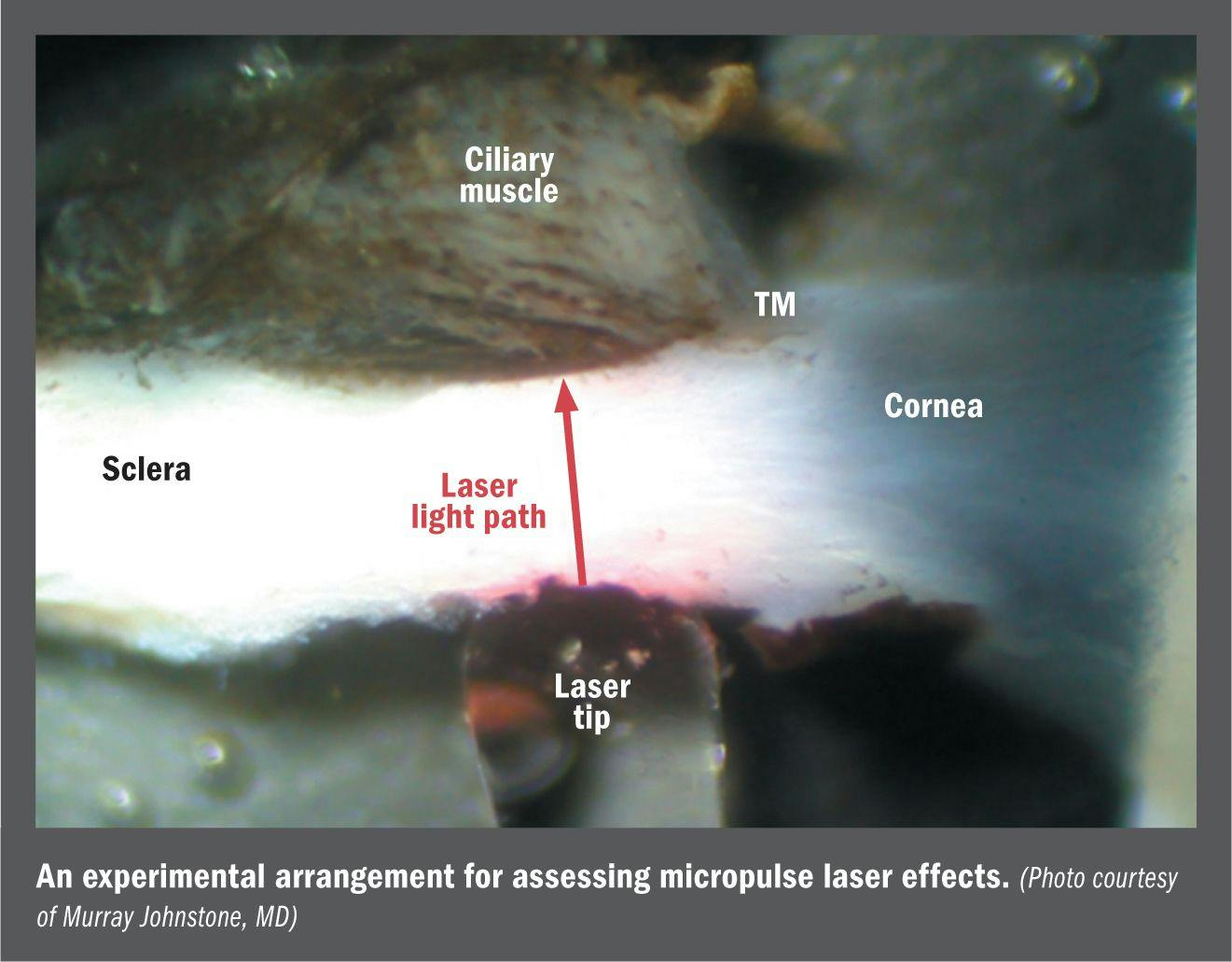 Micropulse laser may increase aqueous outflow