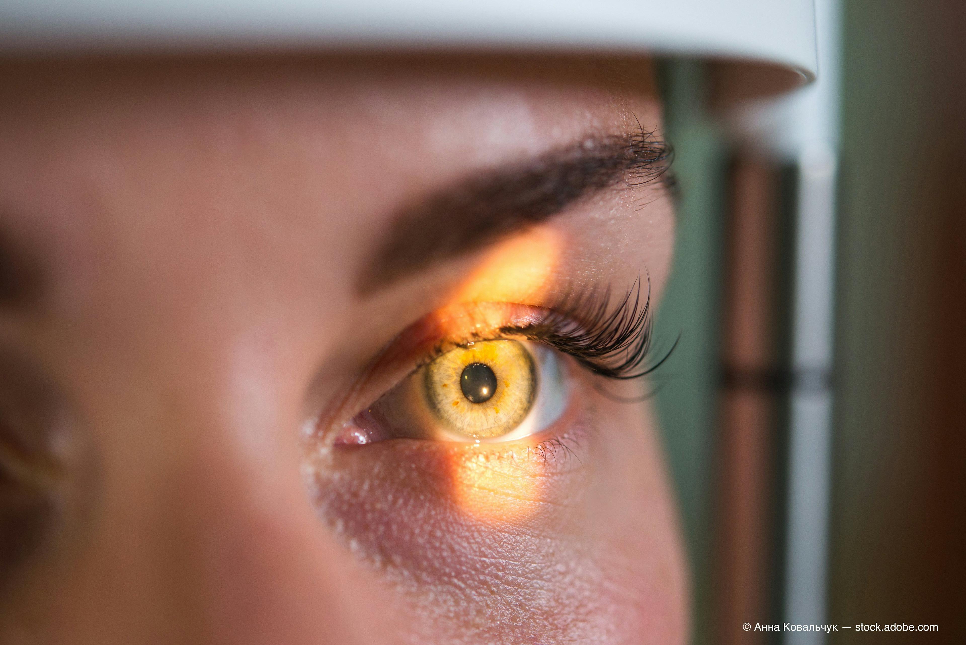 Eye-opener: Sticking to glaucoma therapy regimens vital