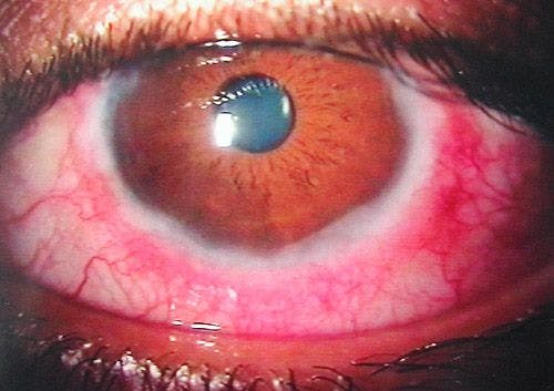 This image shows some of the cornea and conjunctiva findings in vernal conjunctivitis. (File photo)