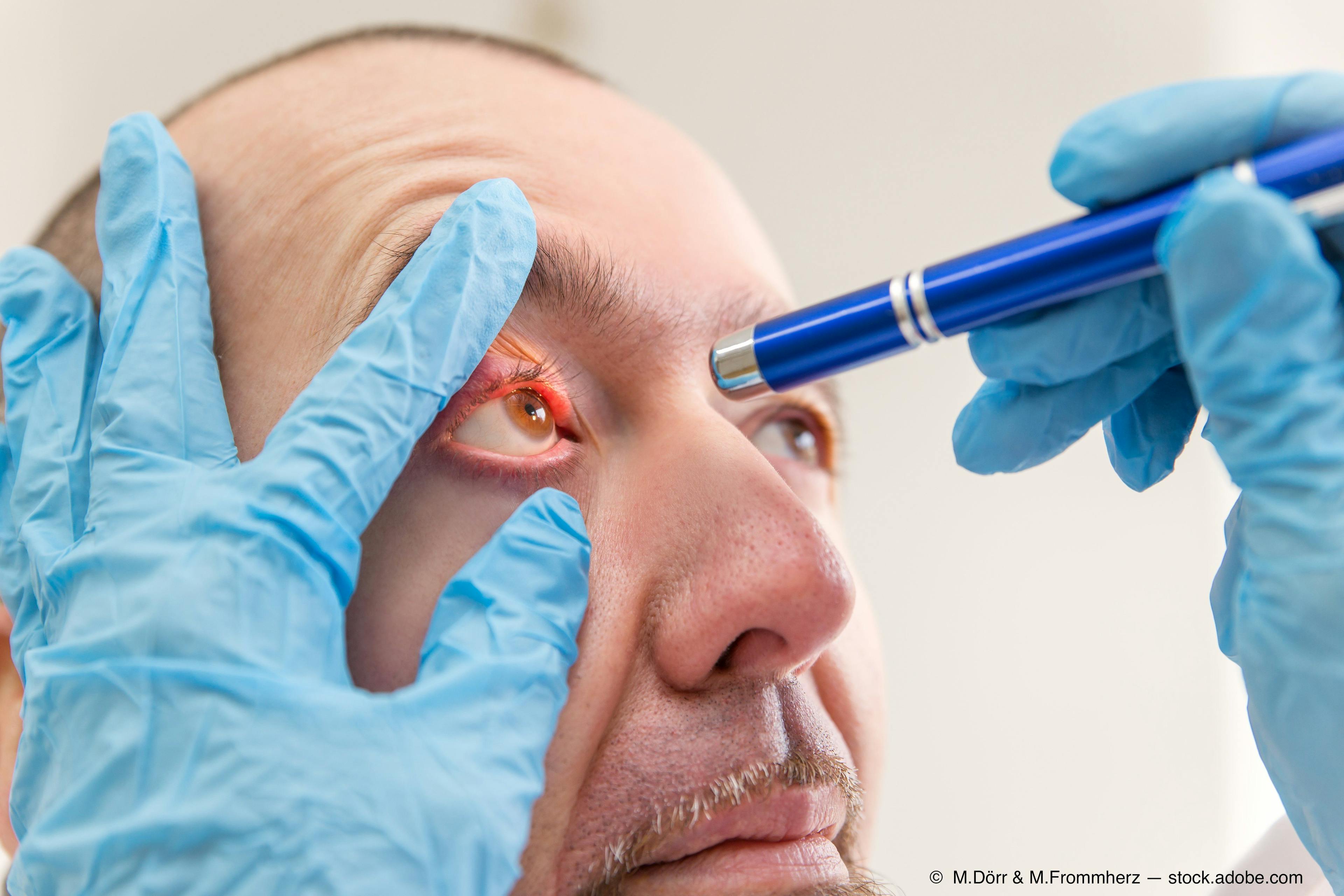 inflammation in eye