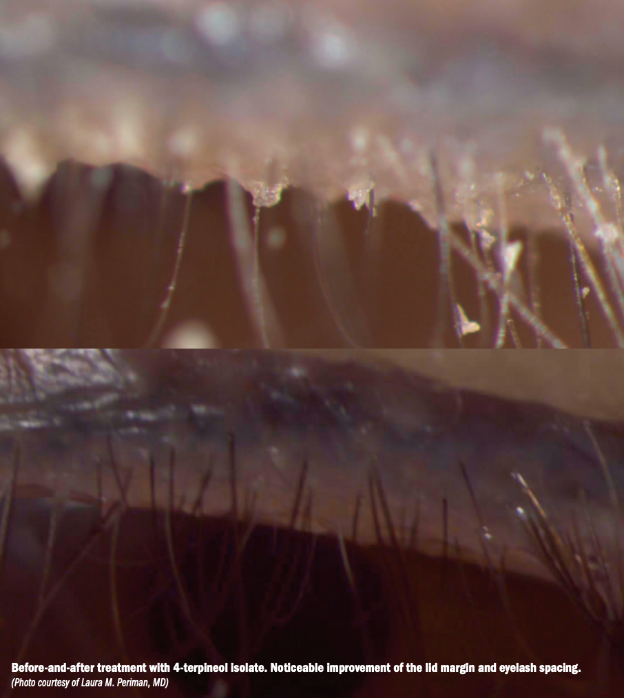 Treating Demodex blepharitis efficiently before surgery