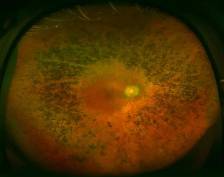 A new hope for a therapy against retinitis pigmentosa
