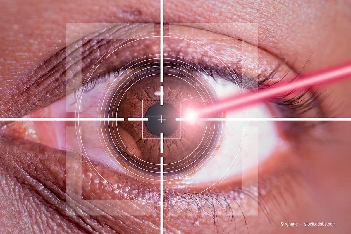 Blog: Refractive Surgery and the Risk of Retinal Detachment 