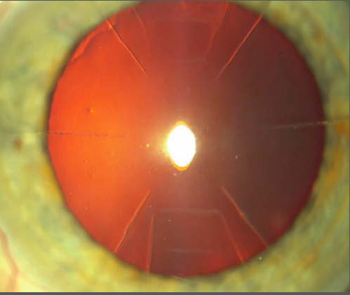 Light-adjustable IOL offers positive refractive results in patients