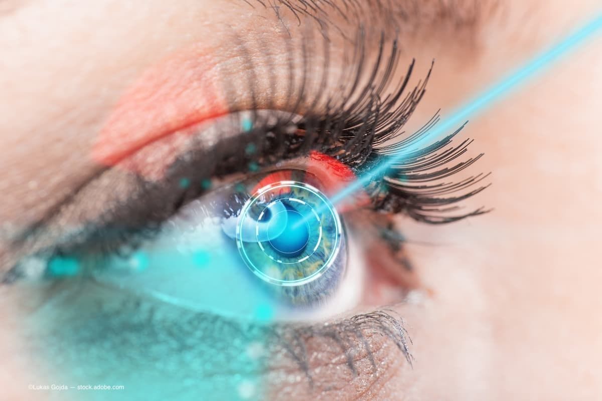 An image of a laser going into a female eye for surgery (Image Credit: AdobeStock/Lukas Gojda)