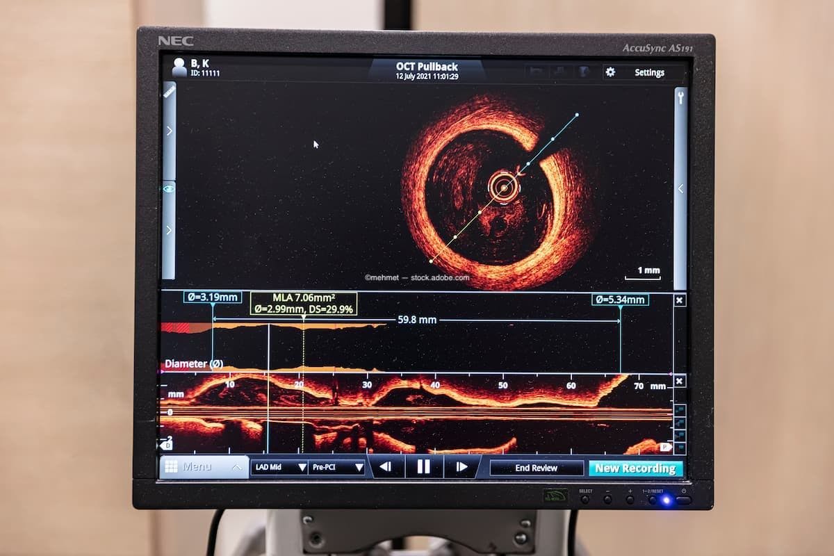 Mount Sinai ophthalmologists develop novel protocol to rapidly diagnose and treat eye stroke