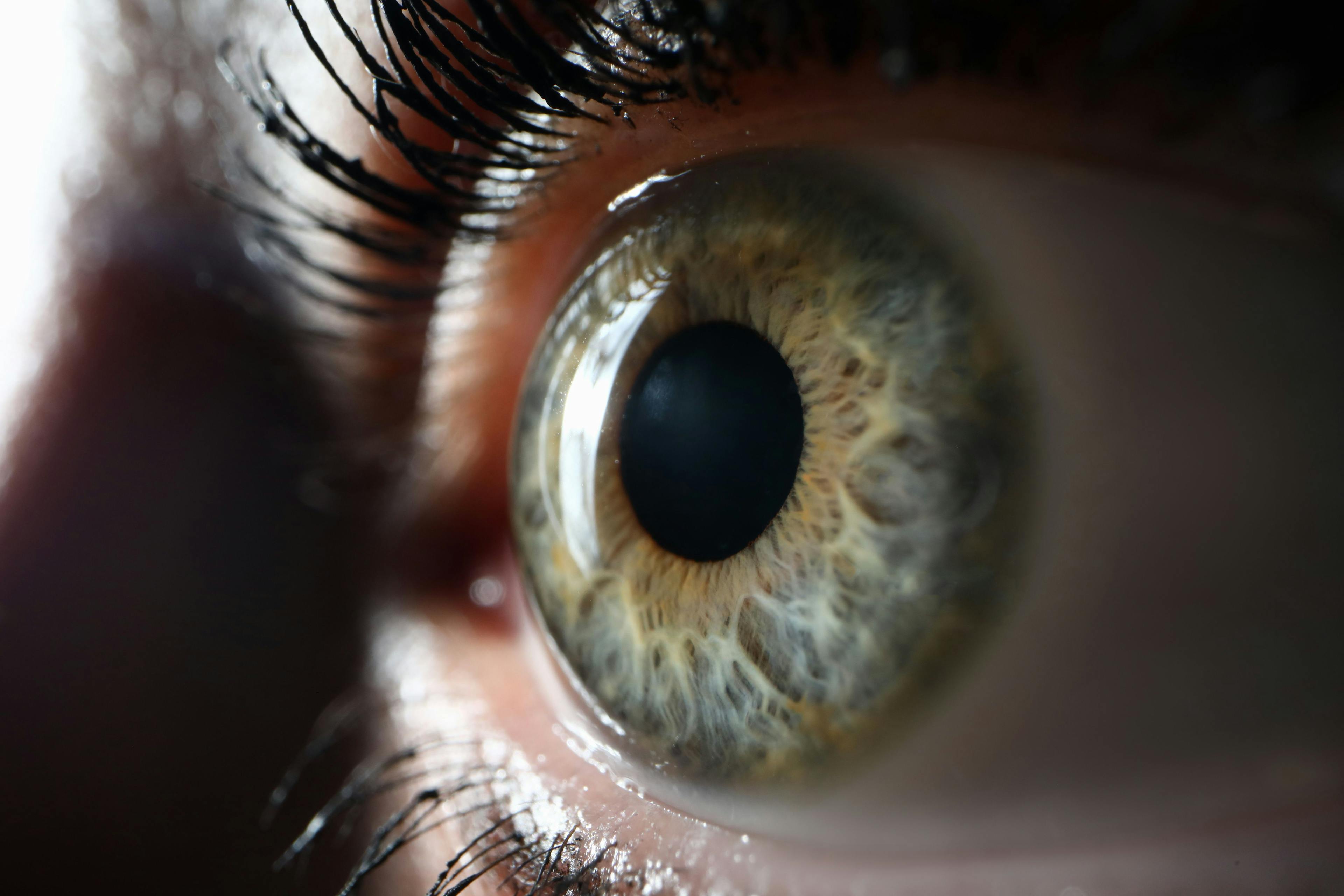 Glaukos offers its first-generation corneal cross-linking therapy, Photrexa, (Epi-off), currently the only FDA-approved treatment shown to slow and halt the progression of keratoconus.