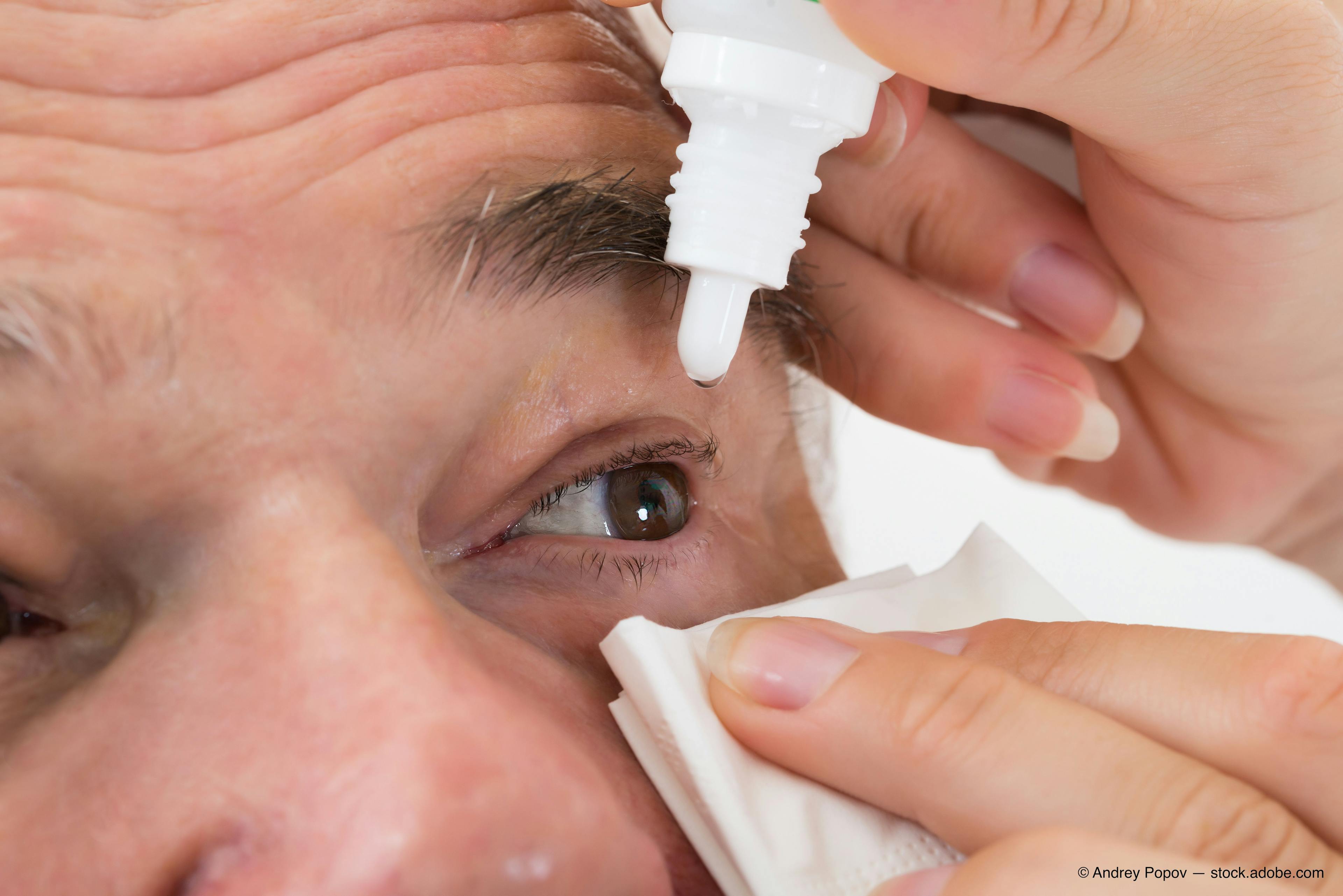 Dry eye severity, treatment varies among ethnic minority patients