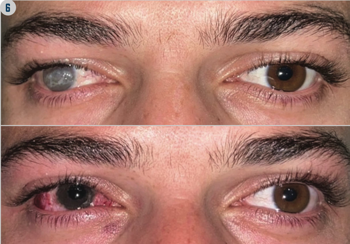 FIGURE 5. Manual Intrastromal Keratopigmentation and Pupil Simulation With Superficial Automated Keratopigmentation. Total corneal leucoma (left) and result after treatment with femtosecond- assisted intrastromal keratopigmentation and superficial automated keratopigmentation for the pupil (right).



FIGURE 6. Keratopigmentation With Strabismus Surgery. Preoperative appearance before keratopigmentation and squint surgery (top) and postoperative result (right). (Images courtesy of Jorge L. Alió, MD, PhD, FEBOphth)