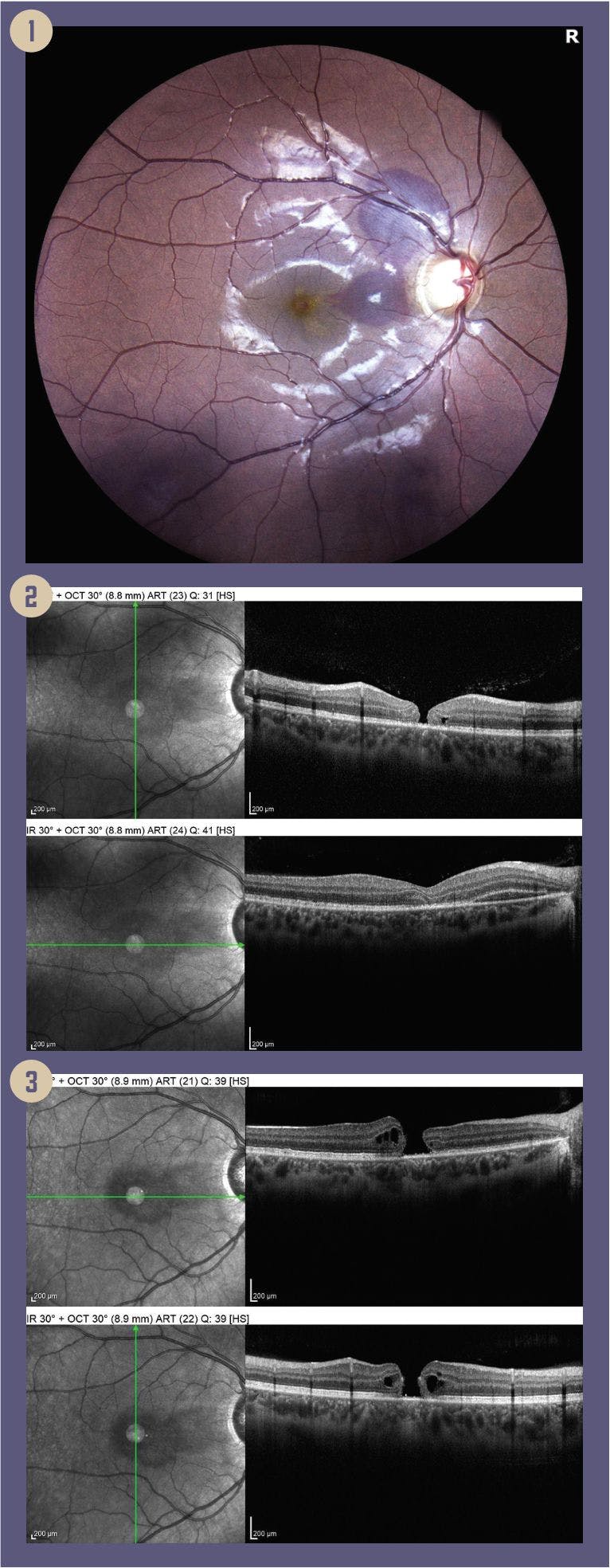 Figures: 1. Traumatic maculopathy, macular hole and subretinal hemorrhage. 2: Macular hole, subretinal hemorrhage, loss of photoreceptor layer. 3: OCT 2 months later, with enlargement of macular hole.