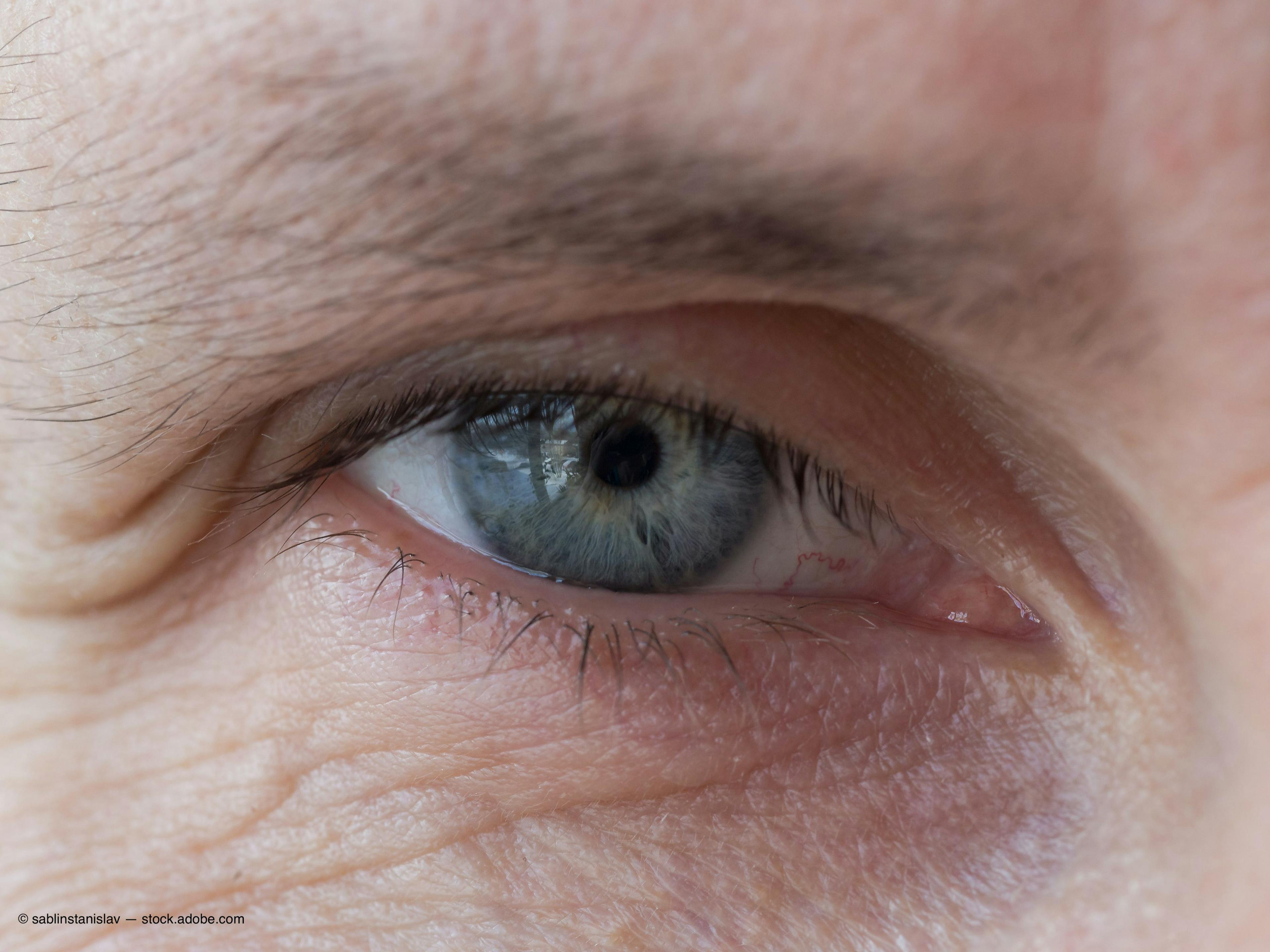 Improve Patient Comfort With Intravitreal Injections