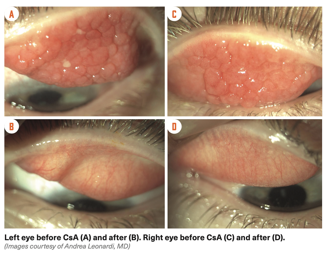 Left eye before CsA (A) and after (B). Right eye before CsA (C) and after (D).