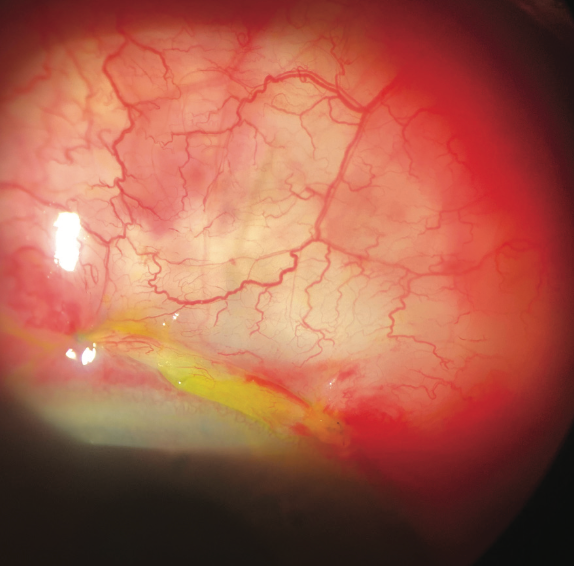 The path to faster visual recovery following glaucoma surgery