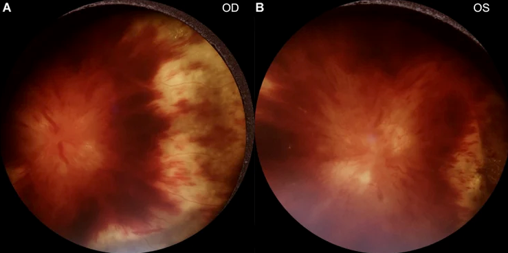 An image from a portable fundus photography camera used by CU ophthalmology residents shows severe papilledema from malignant idiopathic intracranial hypertension. The images became the basis for a paper resident Nihaal Mehta, MD, and faculty published in October 2022. (Image credit: Colorado University Department of Ophthalmology)