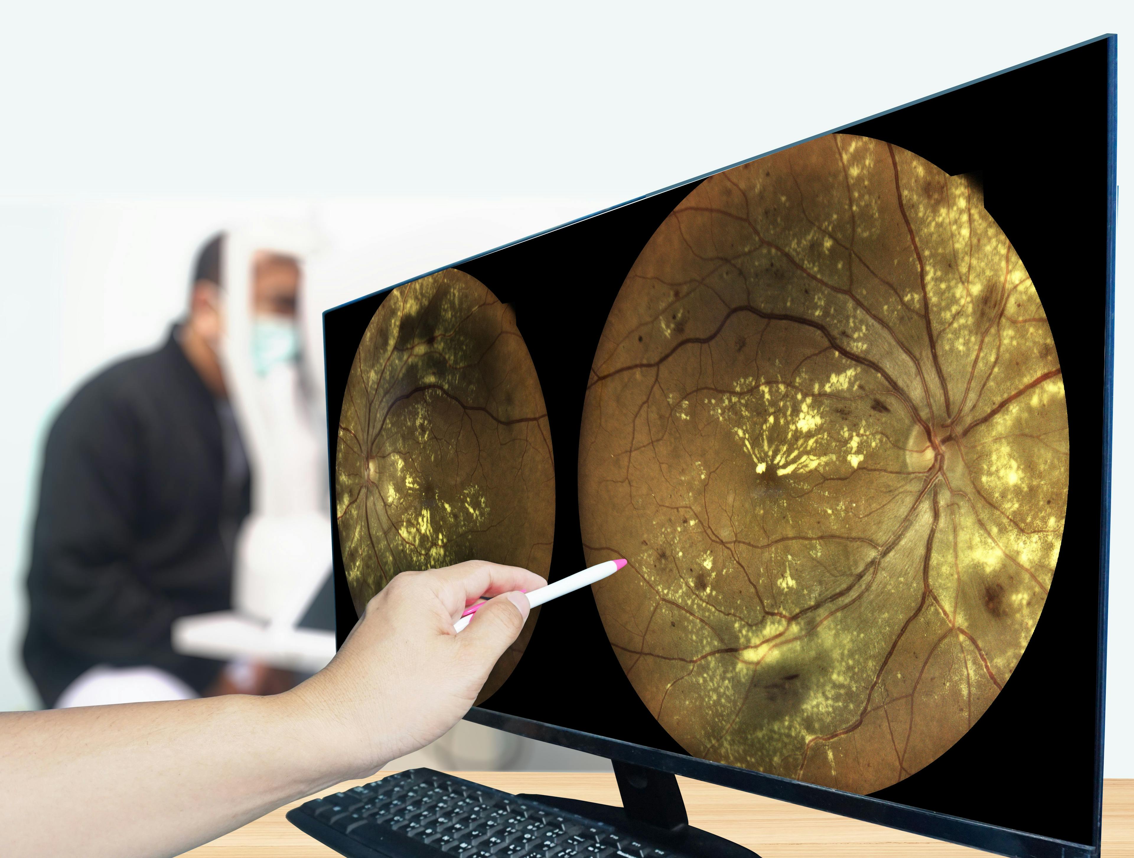 Study: Early anti-VEGF treatment of diabetic retinopathy yields no benefit to visual acuity