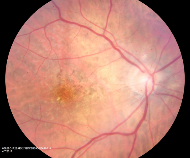 Figure 1. Fundus Photo OD showing macular drusen and RPE changes with no evidence of sub-retinal hemorrhage. 