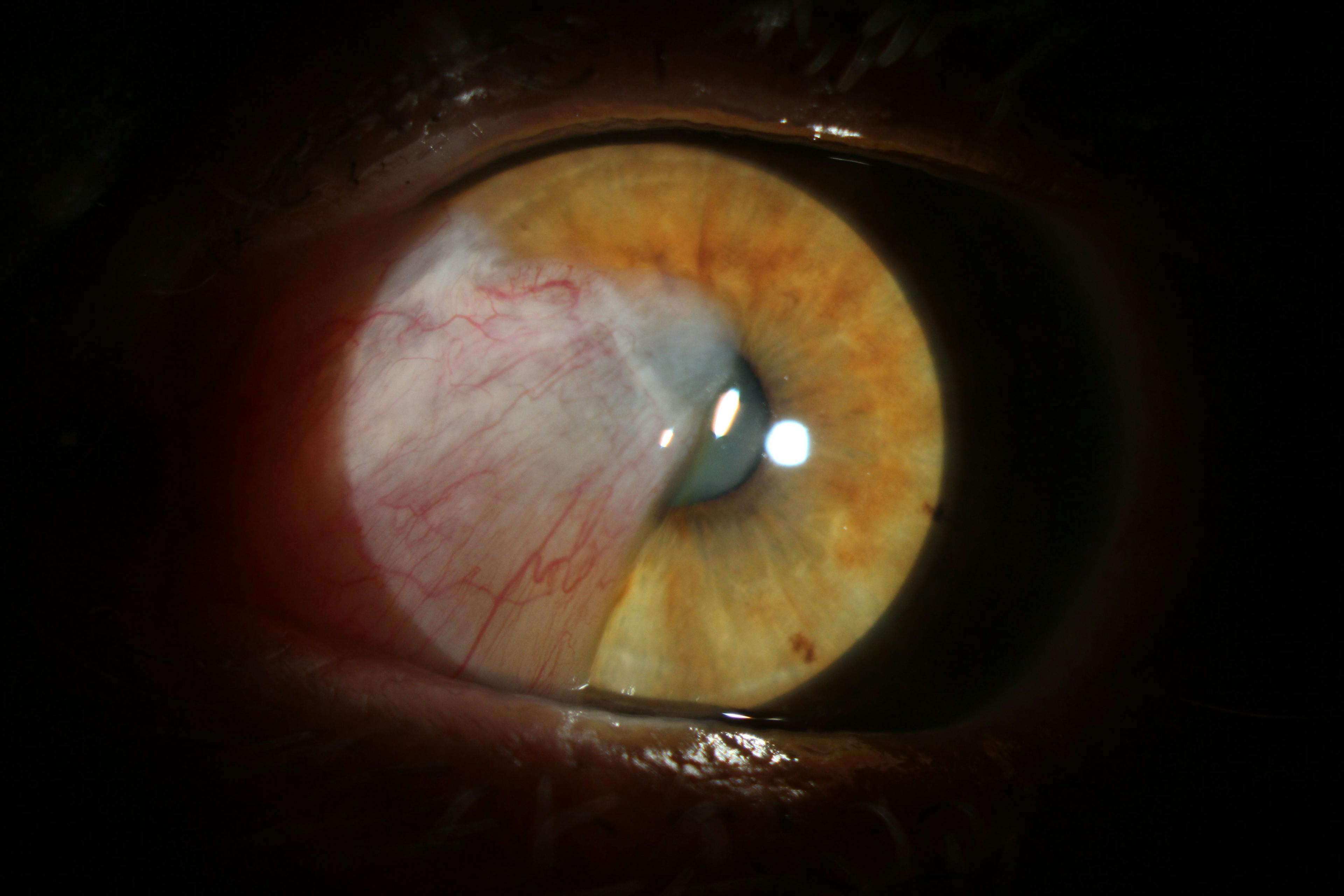 Earlier neurolept anesthesia for laser-assisted cataract surgery: Timing may not be everything
