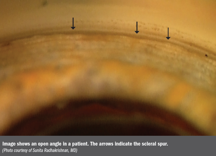 Open angle in a patient with a scleral spur