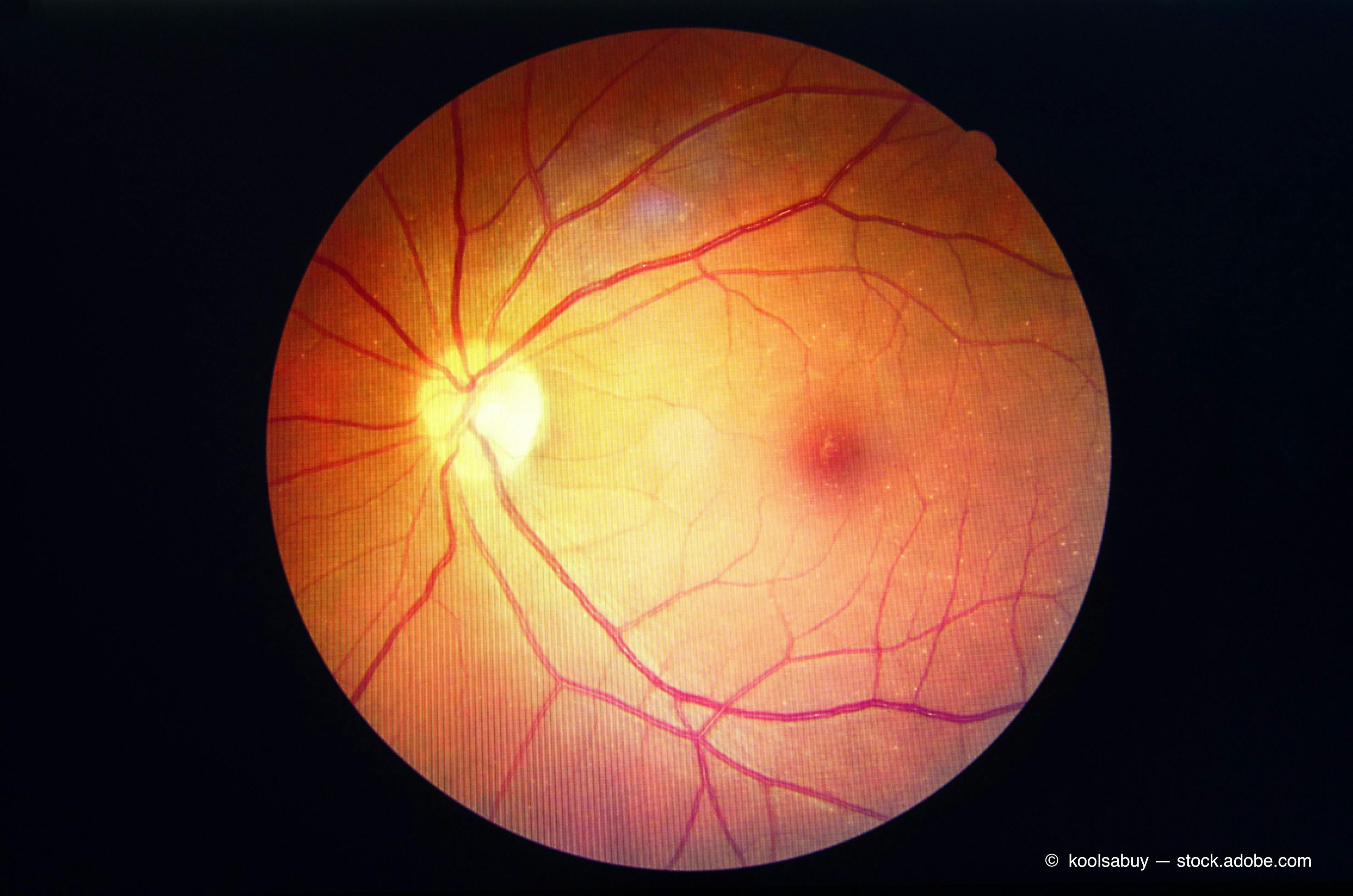 AI and tele-ophthalmology comparable for diagnosing diabetic retinopathy