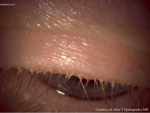 Collarettes are visible on the upper lashes of a patient with Demodex blepharitis. (Image courtesy Alice Epitropoulos, MD)