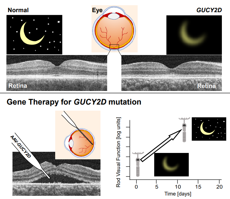Normal night vision depiction and a normal cross-sectional retinal image. Upper right: Reduced vision as a result of mutation in the GUCY2D gene. The near normal retinal image of the patient illustrates why gene therapy was originally recommended. Lower left: The gene therapy procedure shown as a subretinal injection. Lower right:Graph of night vision (rod visual function) improving dramatically over days following treatment (vertical axis is in log units). (Graphic courtesy of Alexander Sumaroka, PhD/University of Pennsylvania)