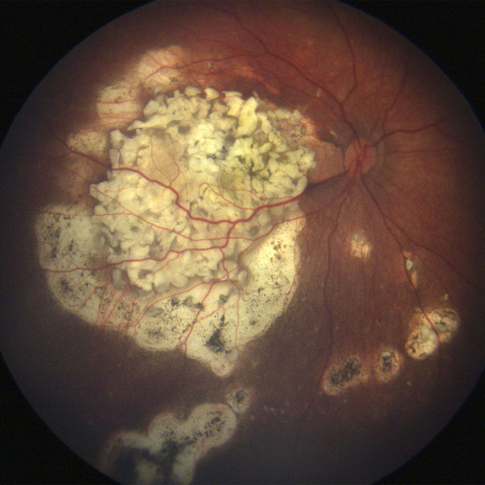 Inactive remnant of retinoblastoma tumor following successful intra-arterial chemotherapy. (Image courtesy of Southwestern Medical Center)