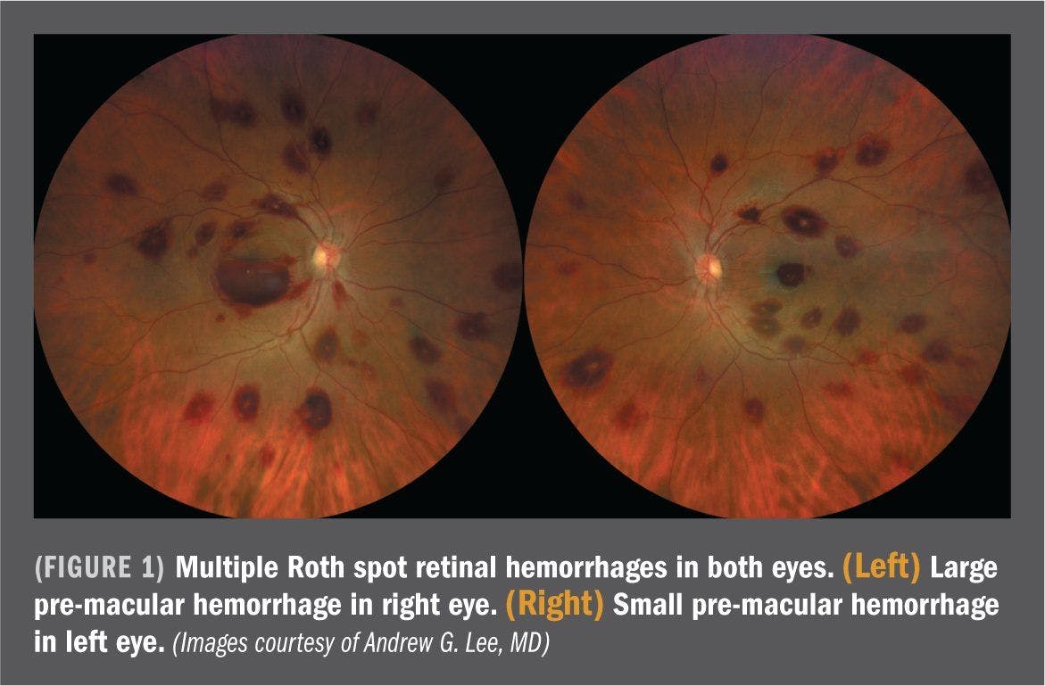 Roth spots may be ocular sign of hemophagocytic lymphohistiocytosis