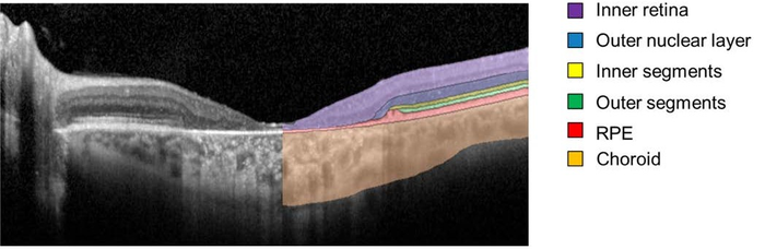 Spectral-domain optical coherence tomography uses light to image layers of the retina. Many scans taken over 5 years were analyzed using deep learning, a type of artificial intelligence in which imaging data are fed into an algorithm that learns how to detect patterns. Six retinal layers were segmented and analyzed for changes in thickness. Image courtesy of the National Eye Institute