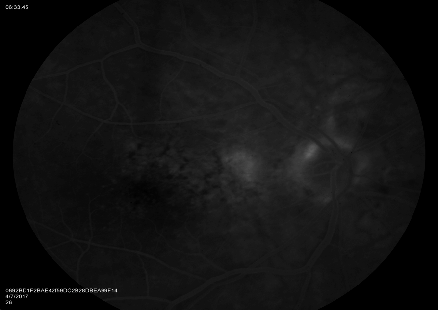 Figure 3. Late phase fluorescein angiography (FA) OD showing late leakage consistent with a CNV lesion just temporal to optic disc. Due to the high index of suspicion with a positive alert from the device, meticulous additional testing with FA was ordered and proved to be critical to diagnose the early CNV lesion.  