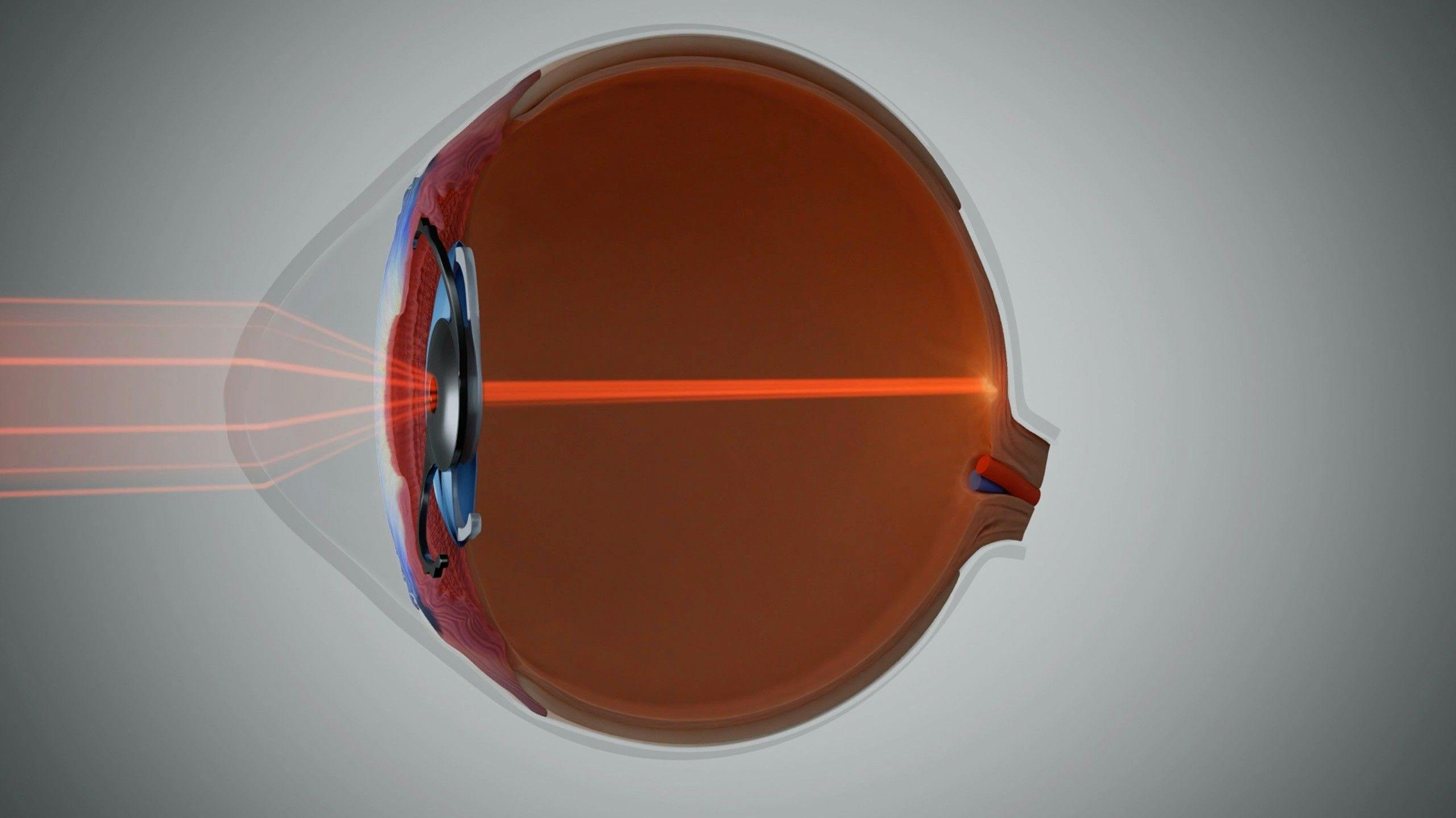 New IOLs for keratoconus and other aberrated corneas