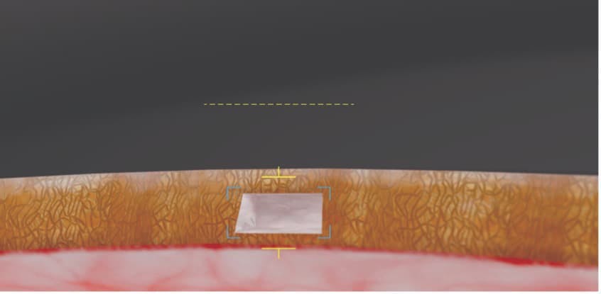 FIGURE 1: FLigHT procedure: A novel, image-guided femtosecond laser noninvasively creates precise trabeculotomy channels through the trabecular meshwork.