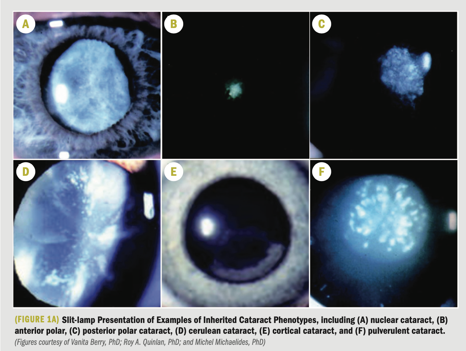 Focus on molecular mechanisms underlying cataract development