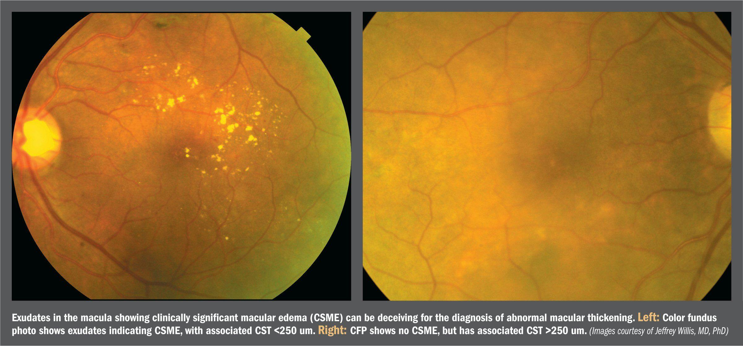 Deep learning predicts OCT measures of diabetic macular thickening