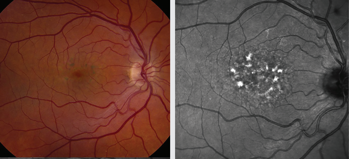 Risk awareness helps identify medication-induced retinal toxicity
