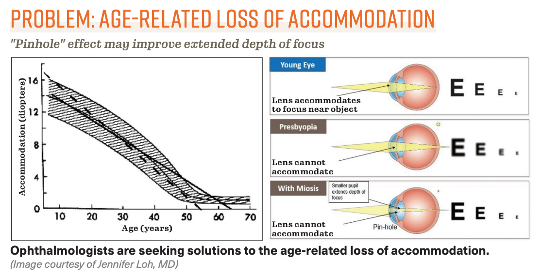 Ophthalmologists are seeking solutions to the age-related loss of accommodation.