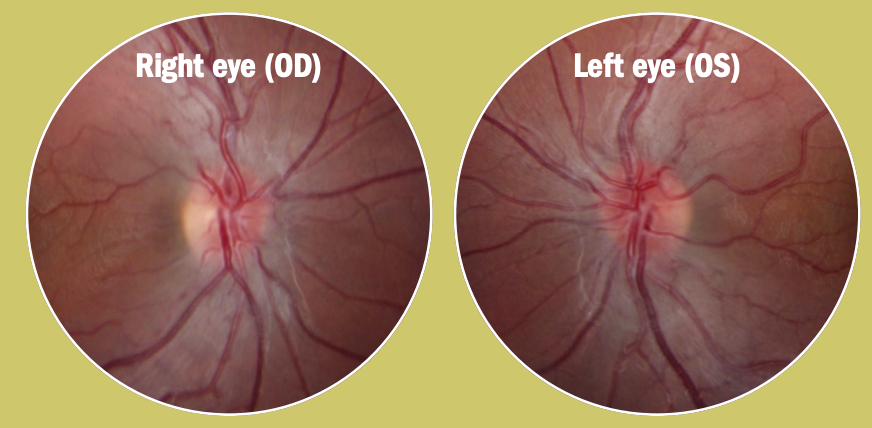 Leber hereditary optic neuropathy: Outlining disease’s natural course