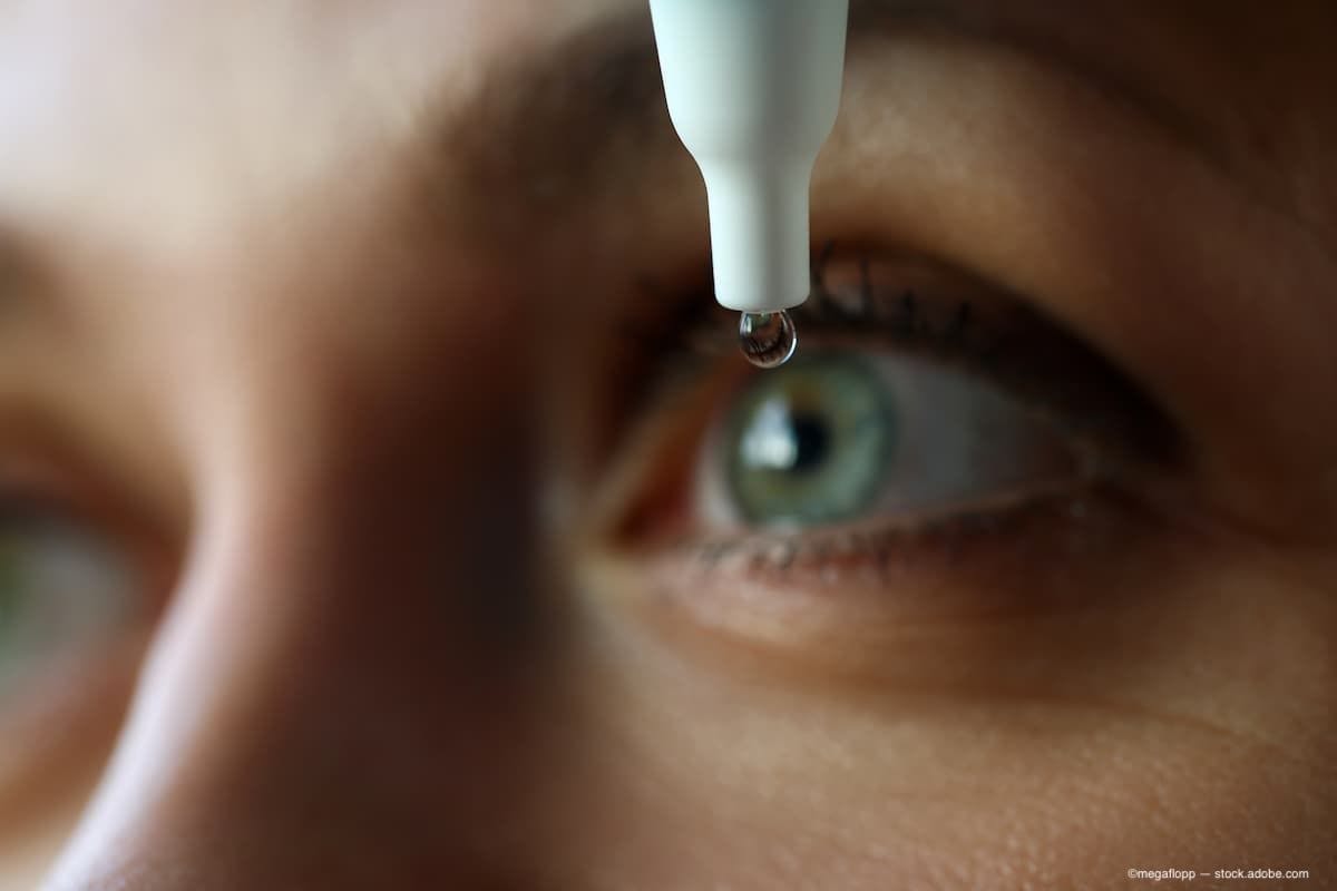 A woman putting eye drops into her eye. (Image Credit: AdbeStock/megaflopp)