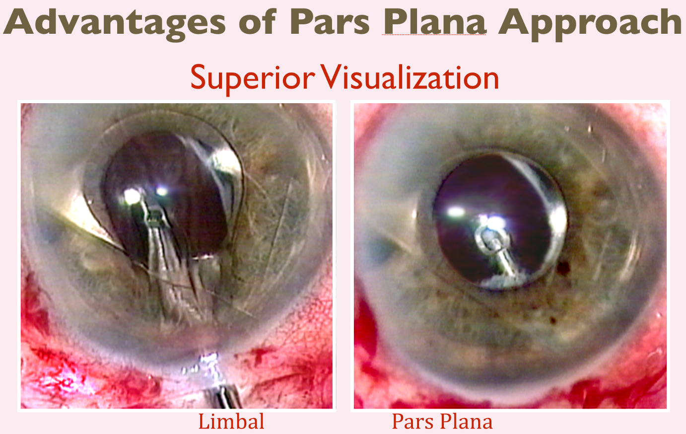 Figure 2. A vitrector placed through the limbus distorts the view, whereas a pars plana entry maintains excellent corneal optics.