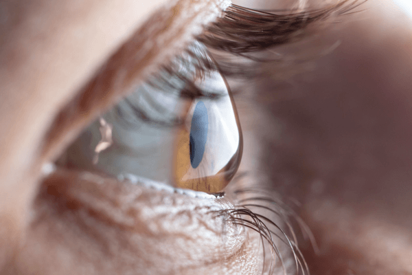 Difference maps key to slowing keratoconus in patients