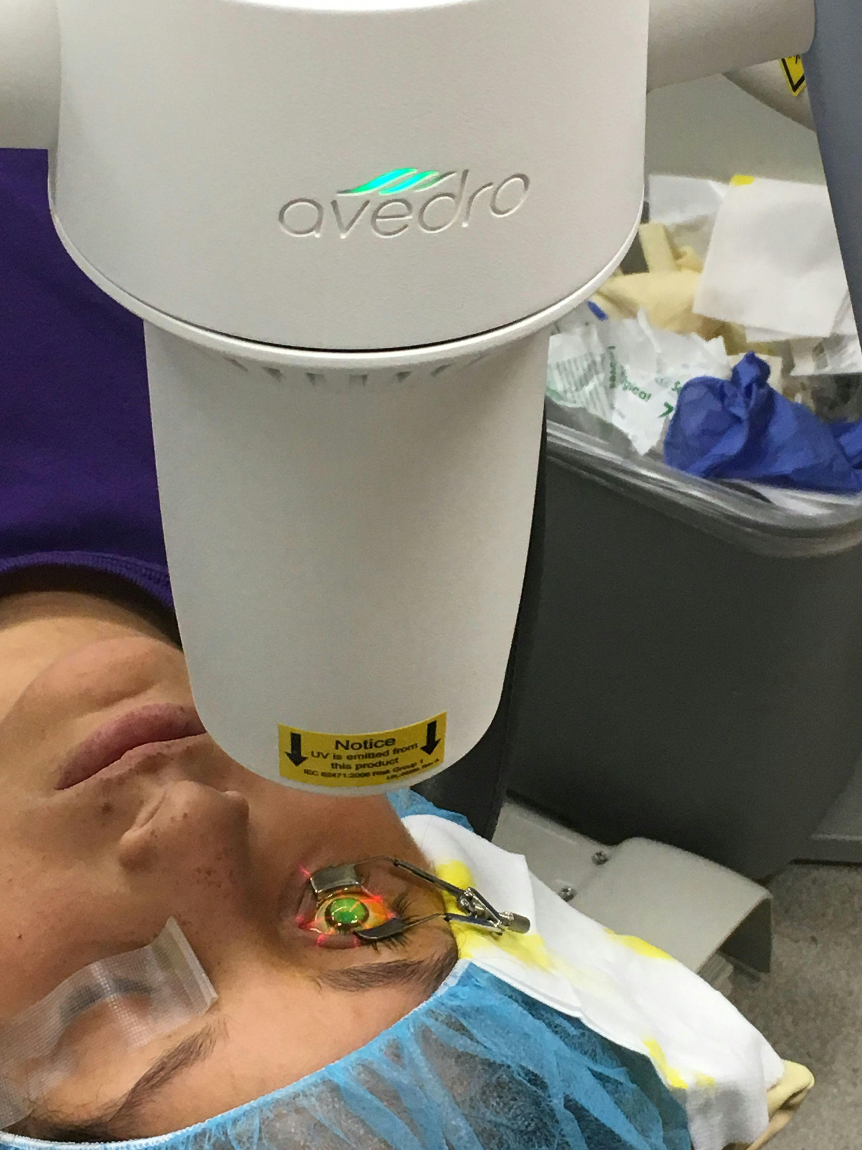 Patient receives CXL treatment (Image courtesy of Avedro).