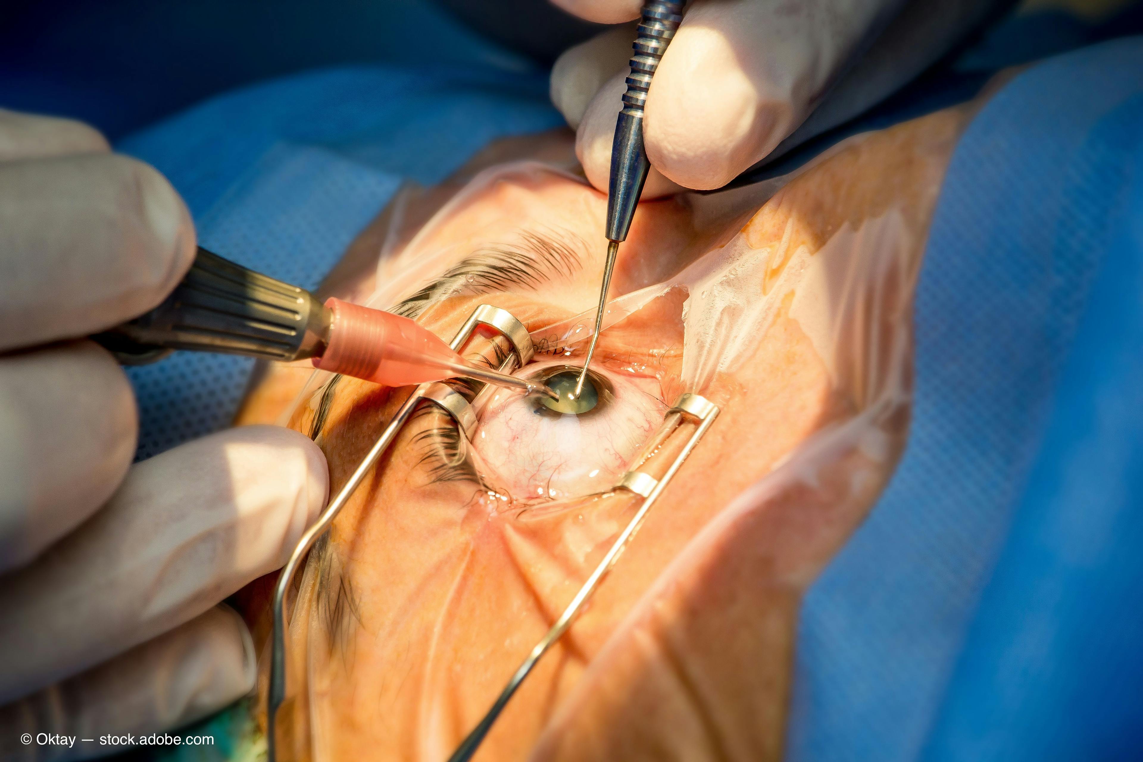 Eye surgery 