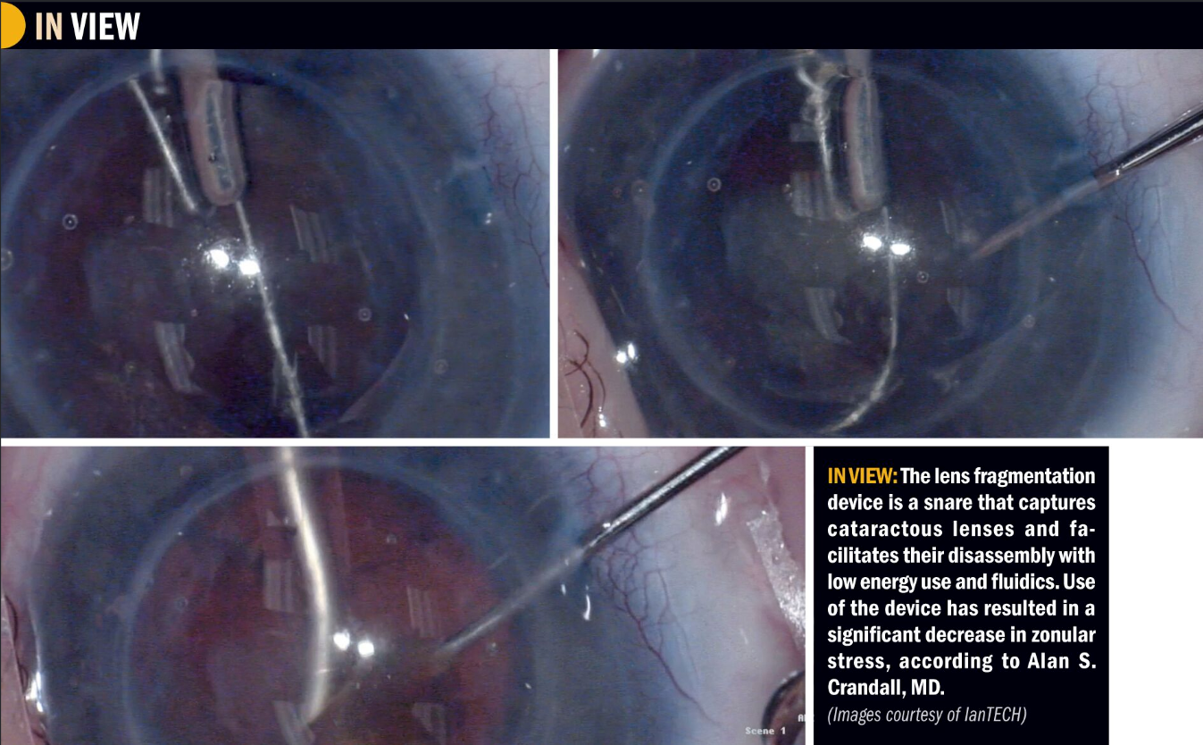 Device manages complex cataract